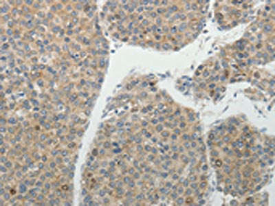 The image on the left is immunohistochemistry of paraffin-embedded Human liver cancer tissue using BIRC5 Antibody(BIRC5 Antibody) at dilution 1/25, on the right is treated with fusion protein. (Original magnification: ×200)