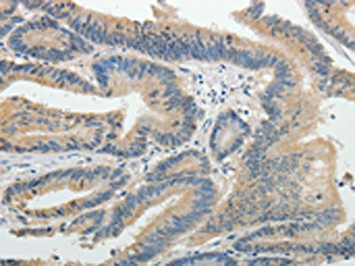 The image on the left is immunohistochemistry of paraffin-embedded Human colon cancer tissue using the antibody Antibody) at dilution 1/25, on the right is treated with fusion protein. (Original magnification: ×200)