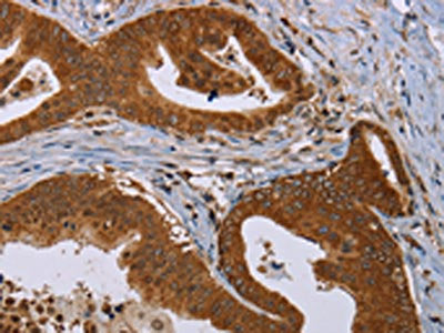The image on the left is immunohistochemistry of paraffin-embedded Human gastric cancer tissue using PIM3 Antibody(PIM3 Antibody) at dilution 1/20, on the right is treated with synthetic peptide. (Original magnification: ×200)Rabbit anti-Human PIM3 Polyclonal Antibody