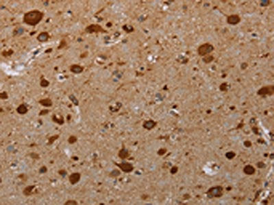 The image on the left is immunohistochemistry of paraffin-embedded Human brain tissue using the antibody Antibody) at dilution 1/20, on the right is treated with synthetic peptide. (Original magnification: ×200)Rabbit anti-Human PIM3 Polyclonal Antibody