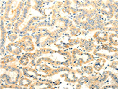 The image on the left is immunohistochemistry of paraffin-embedded Human thyroid cancer tissue using FOXR2 Antibody(FOXR2 Antibody) at dilution 1/25, on the right is treated with fusion protein. (Original magnification: ×200)Rabbit anti-Human FOXR2 Polyclonal Antibody