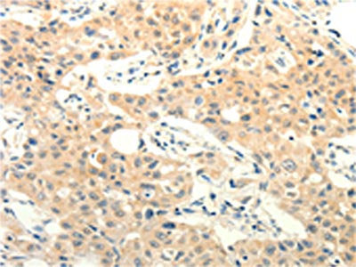 The image on the left is immunohistochemistry of paraffin-embedded Human lung cancer tissue using the antibody Antibody) at dilution 1/25, on the right is treated with fusion protein. (Original magnification: ×200)Rabbit anti-Human FOXR2 Polyclonal Antibody