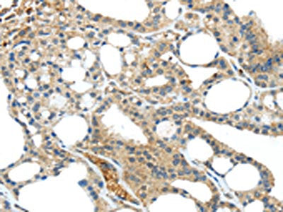 The image on the left is immunohistochemistry of paraffin-embedded Human thyroid cancer tissue using TNIP1 Antibody(TNIP1 Antibody) at dilution 1/40, on the right is treated with synthetic peptide. (Original magnification: ×200)Rabbit anti-Human TNIP1 Polyclonal Antibody