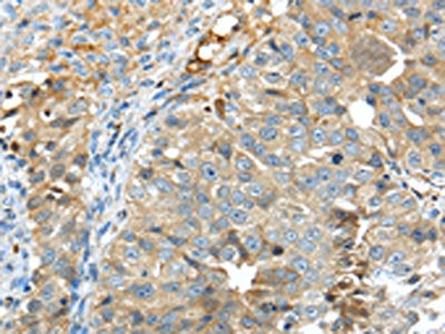 The image on the left is immunohistochemistry of paraffin-embedded Human breast cancer tissue using the antibody Antibody) at dilution 1/40, on the right is treated with synthetic peptide. (Original magnification: ×200)Rabbit anti-Human TNIP1 Polyclonal Antibody