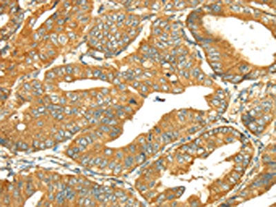 The image on the left is immunohistochemistry of paraffin-embedded Human esophagus cancer tissue using RAB2A Antibody(RAB2A Antibody) at dilution 1/35, on the right is treated with fusion protein. (Original magnification: ×200)Rabbit anti-Human RAB2A Polyclonal Antibody