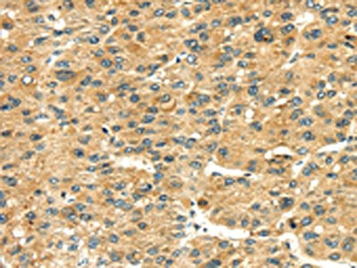 The image on the left is immunohistochemistry of paraffin-embedded Human liver cancer tissue using the antibody Antibody) at dilution 1/35, on the right is treated with fusion protein. (Original magnification: ×200)Rabbit anti-Human RAB2A Polyclonal Antibody
