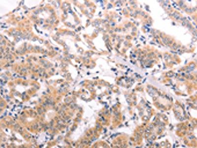 The image on the left is immunohistochemistry of paraffin-embedded Human thyroid cancer tissue using TRAF3IP1 Antibody(TRAF3IP1 Antibody) at dilution 1/50, on the right is treated with fusion protein. (Original magnification: ×200)Rabbit anti-Human TRAF3IP1 Polyclonal Antibody