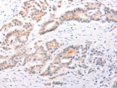 The image on the left is immunohistochemistry of paraffin-embedded Human colon cancer tissue using the antibody Antibody) at dilution 1/50, on the right is treated with fusion protein. (Original magnification: ×200)Rabbit anti-Human TRAF3IP1 Polyclonal Antibody