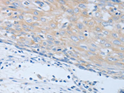 The image on the left is immunohistochemistry of paraffin-embedded Human cervical cancer tissue using CHRNA7 Antibody(CHRFAM7A Antibody) at dilution 1/40, on the right is treated with synthetic peptide. (Original magnification: ×200)Rabbit anti-Human CHRNA7 Polyclonal Antibody