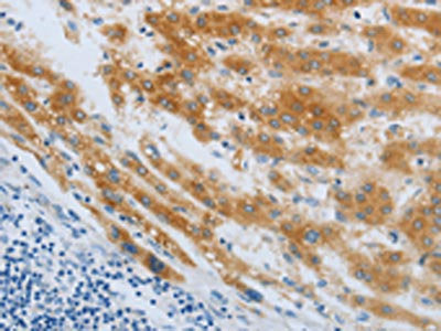 The image on the left is immunohistochemistry of paraffin-embedded Human liver cancer tissue using the antibody Antibody) at dilution 1/40, on the right is treated with synthetic peptide. (Original magnification: ×200)Rabbit anti-Human CHRNA7 Polyclonal Antibody