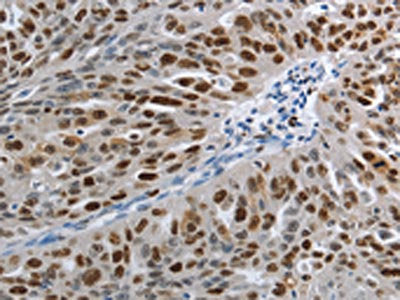 The image on the left is immunohistochemistry of paraffin-embedded Human ovarian cancer tissue using MCM3 Antibody(MCM3 Antibody) at dilution 1/30, on the right is treated with fusion protein. (Original magnification: ×200)
