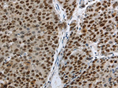 The image on the left is immunohistochemistry of paraffin-embedded Human liver cancer tissue using the antibody Antibody) at dilution 1/30, on the right is treated with fusion protein. (Original magnification: ×200)