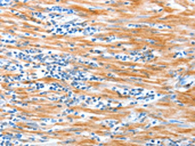 The image on the left is immunohistochemistry of paraffin-embedded Human esophagus cancer tissue using ALDOB Antibody(ALDOB Antibody) at dilution 1/40, on the right is treated with synthetic peptide. (Original magnification: ×200)Rabbit anti-Human ALDOB Polyclonal Antibody