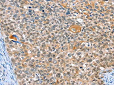 The image on the left is immunohistochemistry of paraffin-embedded Human cervical cancer tissue using the antibody Antibody) at dilution 1/40, on the right is treated with synthetic peptide. (Original magnification: ×200)Rabbit anti-Human ALDOB Polyclonal Antibody