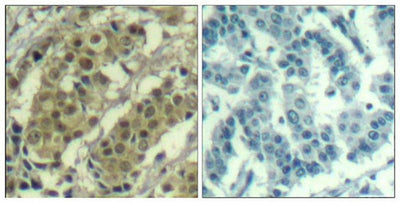 Immunohistochemical analysis of paraffin-embedded human breast carcinoma tissue using AKT1(Ab-450) Antibody(left) or the same antibody preincubated with blocking peptide(right).Rabbit anti-Human AKT1 Polyclonal Antibody