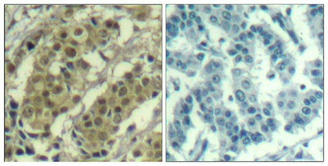 Immunohistochemical analysis of paraffin-embedded human breast carcinoma tissue using AKT1(Ab-450) Antibody(left) or the same antibody preincubated with blocking peptide(right).Rabbit anti-Human AKT1 Polyclonal Antibody