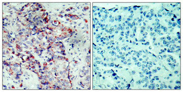 Immunohistochemical analysis of paraffin-embedded human breast carcinoma tissue using SEK1/MKK4(Phospho-Ser80) Antibody(left) or the same antibody preincubated with blocking peptide(right).