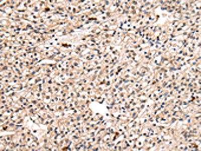 The image on the left is immunohistochemistry of paraffin-embedded Human prostate cancer tissue using PPIL1 Antibody(PPIL1 Antibody) at dilution 1/30, on the right is treated with fusion protein. (Original magnification: ×200)Rabbit anti-Human PPIL1 Polyclonal Antibody