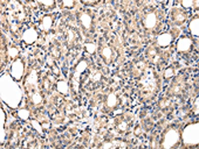 The image on the left is immunohistochemistry of paraffin-embedded Human thyroid cancer tissue using the antibody Antibody) at dilution 1/30, on the right is treated with fusion protein. (Original magnification: ×200)Rabbit anti-Human PPIL1 Polyclonal Antibody