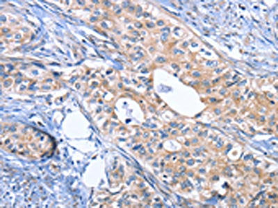 The image on the left is immunohistochemistry of paraffin-embedded Human cervical cancer tissue using INHBC Antibody(INHBC Antibody) at dilution 1/50, on the right is treated with fusion protein. (Original magnification: ×200)
