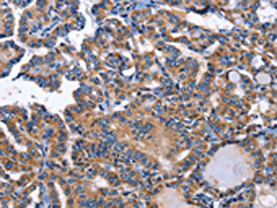 The image on the left is immunohistochemistry of paraffin-embedded Human thyroid cancer tissue using the antibody Antibody) at dilution 1/50, on the right is treated with fusion protein. (Original magnification: ×200)