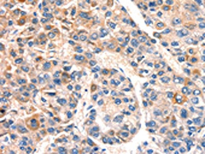 The image on the left is immunohistochemistry of paraffin-embedded Human liver cancer tissue using BCL3 Antibody(BCL3 Antibody) at dilution 1/15, on the right is treated with synthetic peptide. (Original magnification: ×200)