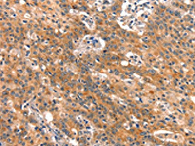 The image on the left is immunohistochemistry of paraffin-embedded Human gastic cancer tissue using the antibody Antibody) at dilution 1/15, on the right is treated with synthetic peptide. (Original magnification: ×200)