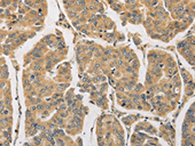 The image on the left is immunohistochemistry of paraffin-embedded Human breast cancer tissue using DDX19B Antibody(DDX19B Antibody) at dilution 1/20, on the right is treated with fusion protein. (Original magnification: ×200)Rabbit anti-Human DDX19B Polyclonal Antibody