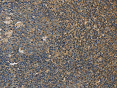The image on the left is immunohistochemistry of paraffin-embedded Human tonsil tissue using the antibody Antibody) at dilution 1/20, on the right is treated with fusion protein. (Original magnification: ×200)Rabbit anti-Human DDX19B Polyclonal Antibody