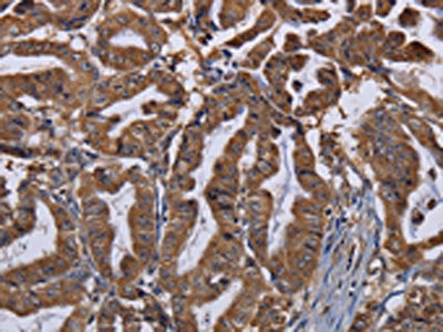 The image on the left is immunohistochemistry of paraffin-embedded Human esophagus cancer tissue using MCTS1 Antibody(MCTS1 Antibody) at dilution 1/30, on the right is treated with fusion protein. (Original magnification: ×200)