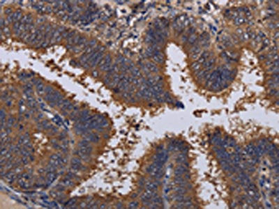 The image on the left is immunohistochemistry of paraffin-embedded Human colon cancer tissue using the antibody Antibody) at dilution 1/30, on the right is treated with fusion protein. (Original magnification: ×200)