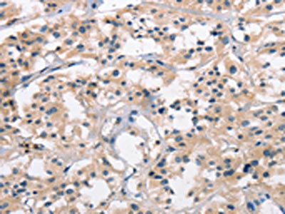 The image on the left is immunohistochemistry of paraffin-embedded Human thyroid cancer tissue using SENP1 Antibody(SENP1 Antibody) at dilution 1/25, on the right is treated with synthetic peptide. (Original magnification: ×200)Rabbit anti-Human SENP1 Polyclonal Antibody