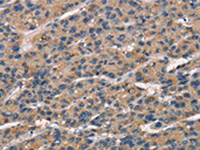 The image on the left is immunohistochemistry of paraffin-embedded Human liver cancer tissue using the antibody Antibody) at dilution 1/25, on the right is treated with synthetic peptide. (Original magnification: ×200)Rabbit anti-Human SENP1 Polyclonal Antibody