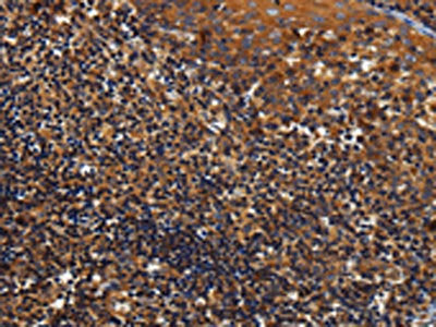 The image on the left is immunohistochemistry of paraffin-embedded Human tonsil tissue using KCNK17 Antibody(KCNK17 Antibody) at dilution 1/60, on the right is treated with fusion protein. (Original magnification: ×200)