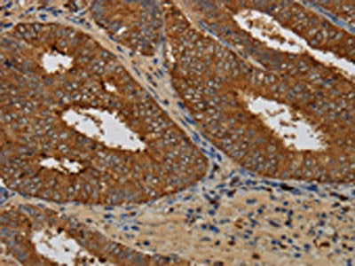 The image on the left is immunohistochemistry of paraffin-embedded Human colon cancer tissue using the antibody Antibody) at dilution 1/60, on the right is treated with fusion protein. (Original magnification: ×200)