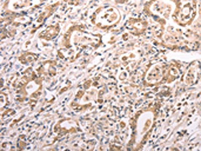 The image on the left is immunohistochemistry of paraffin-embedded Human gastric cancer tissue using TXN Antibody(TXN Antibody) at dilution 1/30, on the right is treated with synthetic peptide. (Original magnification: ×200)Rabbit anti-Human TXN Polyclonal Antibody