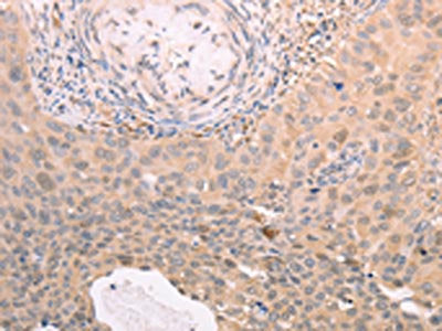 The image on the left is immunohistochemistry of paraffin-embedded Human cervical cancer tissue using the antibody Antibody) at dilution 1/30, on the right is treated with synthetic peptide. (Original magnification: ×200)Rabbit anti-Human TXN Polyclonal Antibody