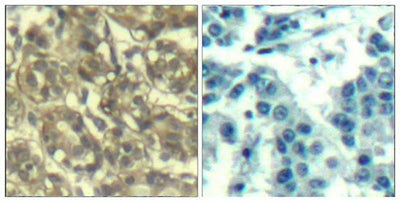Immunohistochemical analysis of paraffin-embedded human breast carcinoma tissue using Cyclin B1(Ab-147) Antibody(left) or the same antibody preincubated with blocking peptide(right).Rabbit anti-Human CCNB1 Polyclonal Antibody