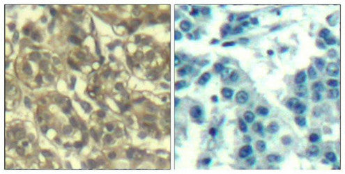 Immunohistochemical analysis of paraffin-embedded human breast carcinoma tissue using Cyclin B1(Ab-147) Antibody(left) or the same antibody preincubated with blocking peptide(right).Rabbit anti-Human CCNB1 Polyclonal Antibody