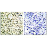 Immunohistochemical analysis of paraffin-embedded human breast carcinoma tissue using PCNA antibody.Rabbit anti-Human PCNA Polyclonal Antibody