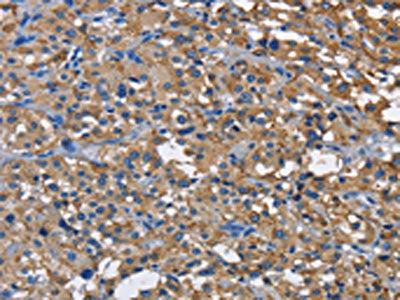 The image on the left is immunohistochemistry of paraffin-embedded Human thyroid cancer tissue using the antibody Antibody) at dilution 1/60, on the right is treated with fusion protein. (Original magnification: ×200)Rabbit anti-Human CD160 Polyclonal Antibody