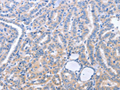 The image on the left is immunohistochemistry of paraffin-embedded Human thyroid cancer tissue using the antibody Antibody) at dilution 1/40, on the right is treated with synthetic peptide. (Original magnification: ×200)