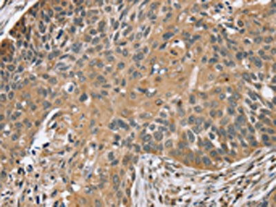 The image on the left is immunohistochemistry of paraffin-embedded Human esophagus cancer tissue using TRIM3 Antibody(TRIM3 Antibody) at dilution 1/45, on the right is treated with synthetic peptide. (Original magnification: ×200)Rabbit anti-Human TRIM3 Polyclonal Antibody