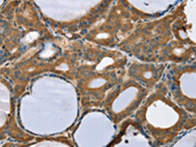 The image on the left is immunohistochemistry of paraffin-embedded Human thyroid cancer tissue using the antibody Antibody) at dilution 1/45, on the right is treated with synthetic peptide. (Original magnification: ×200)Rabbit anti-Human TRIM3 Polyclonal Antibody