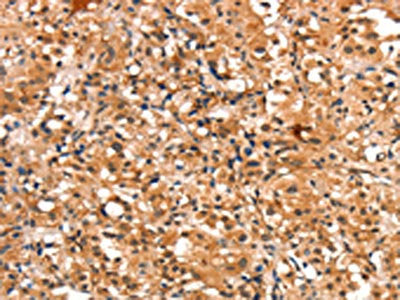 The image on the left is immunohistochemistry of paraffin-embedded Human thyroid cancer tissue using CHUK Antibody(CHUK Antibody) at dilution 1/15, on the right is treated with synthetic peptide. (Original magnification: ×200)Rabbit anti-Human CHUK Polyclonal Antibody