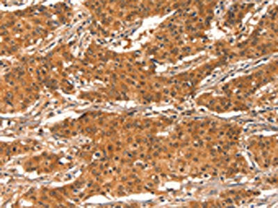 The image on the left is immunohistochemistry of paraffin-embedded Human gastic cancer tissue using the antibody Antibody) at dilution 1/15, on the right is treated with synthetic peptide. (Original magnification: ×200)Rabbit anti-Human CHUK Polyclonal Antibody