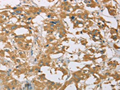 The image on the left is immunohistochemistry of paraffin-embedded Human thyroid cancer tissue using EIF3F Antibody(EIF3F Antibody) at dilution 1/30, on the right is treated with fusion protein. (Original magnification: ×200)Rabbit anti-Human EIF3F Polyclonal Antibody