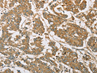 The image on the left is immunohistochemistry of paraffin-embedded Human colon cancer tissue using the antibody Antibody) at dilution 1/30, on the right is treated with fusion protein. (Original magnification: ×200)Rabbit anti-Human EIF3F Polyclonal Antibody