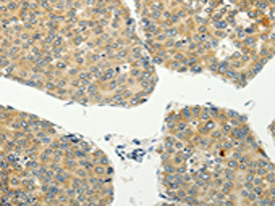 The image on the left is immunohistochemistry of paraffin-embedded Human liver cancer  tissue using SPIN4 Antibody(SPIN4 Antibody) at dilution 1/20, on the right is treated with fusion protein. (Original magnification: ×200)Rabbit anti-Human SPIN4 Polyclonal Antibody