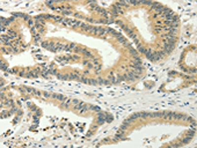 The image on the left is immunohistochemistry of paraffin-embedded Human colon cancer  tissue using the antibody Antibody) at dilution 1/20, on the right is treated with fusion protein. (Original magnification: ×200)Rabbit anti-Human SPIN4 Polyclonal Antibody